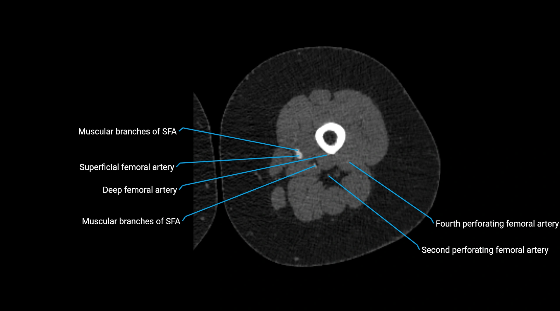 CTA lower limb cross sectional anatomy labelled image _134.webp